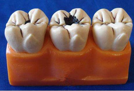 蛀牙真的是虫蛀的嘛,蛀牙是真的有虫吗视频