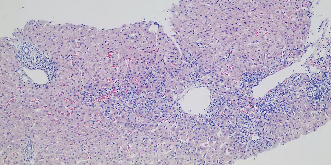 精华回顾｜肝胆精英荟：肝脏炎症性损伤的临床及病理鉴别诊断——杨永峰教授