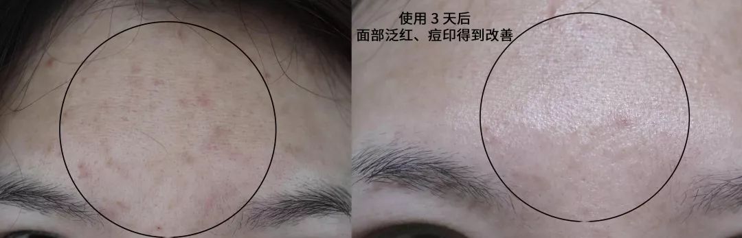 如何拯救长痘的脸,长痘肌肤日常如何护理