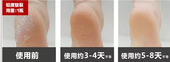 快速修复手干裂,冬季皮肤干燥脱皮面霜