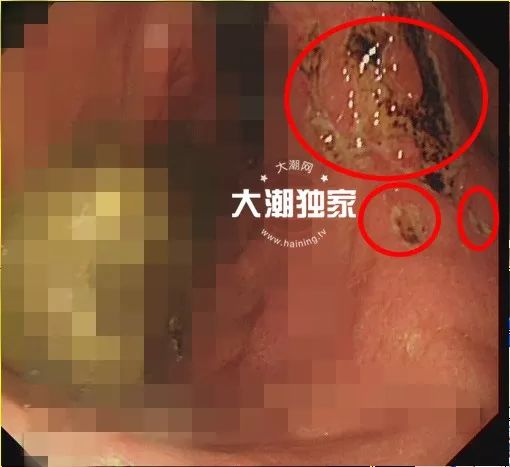 「925丨提醒」男子体内长了两大团……医生却说：快喝可乐！喝一个星期！