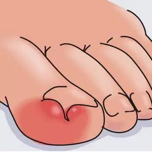 十六岁女孩六年不剪脚趾甲,11岁女孩没有剪过指甲