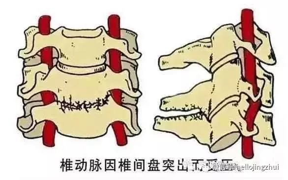 颈椎病压迫神经吃甲钴胺多长时间,颈椎病压迫神经微创手术要多少钱