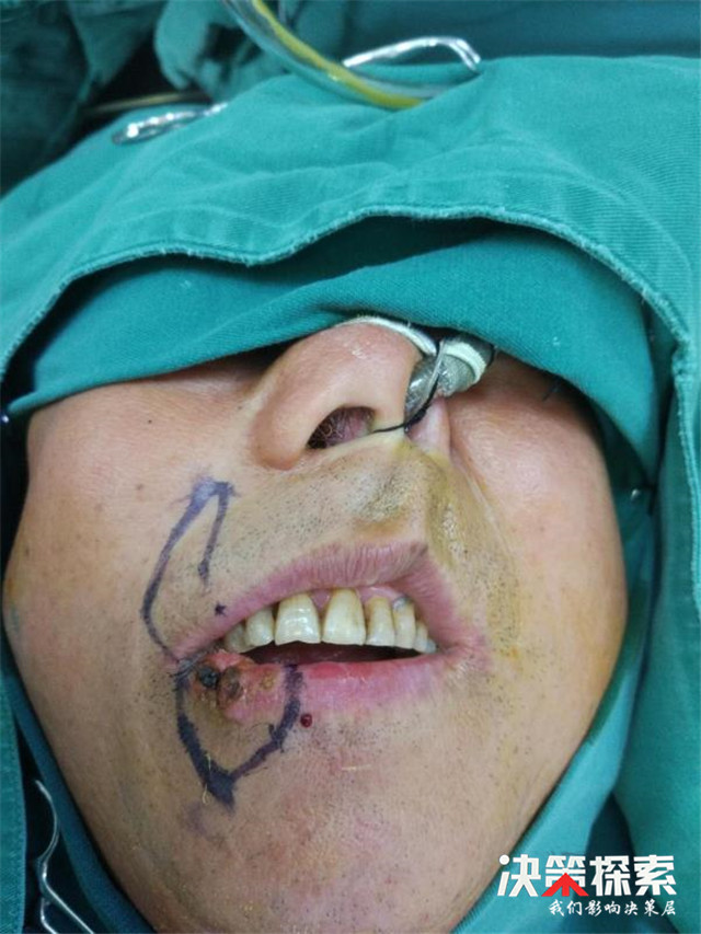 嘴唇肿块是癌症的早期信号,上嘴唇长了个肿瘤医生就说癌了