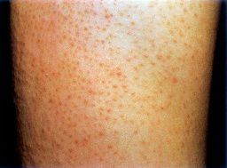 鸡皮肤解决方法又白又嫩学生适用,鸡皮肤太丑了该怎么办