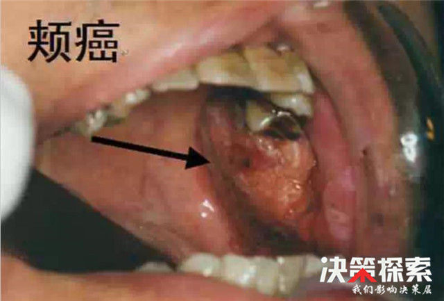 当心！南阳69岁老伯嘴里血疱不愈竟成口颊癌