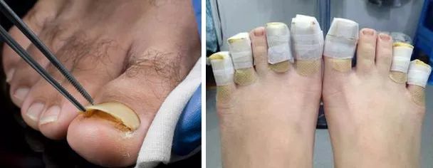 十年灰指甲可以治好吗,一次搞定顽固灰指甲