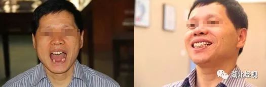 全城征集免费种植牙,全城征集免费种牙