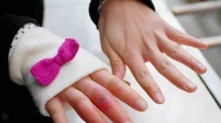 防治冻疮教案,如何正确预防和处理冻疮