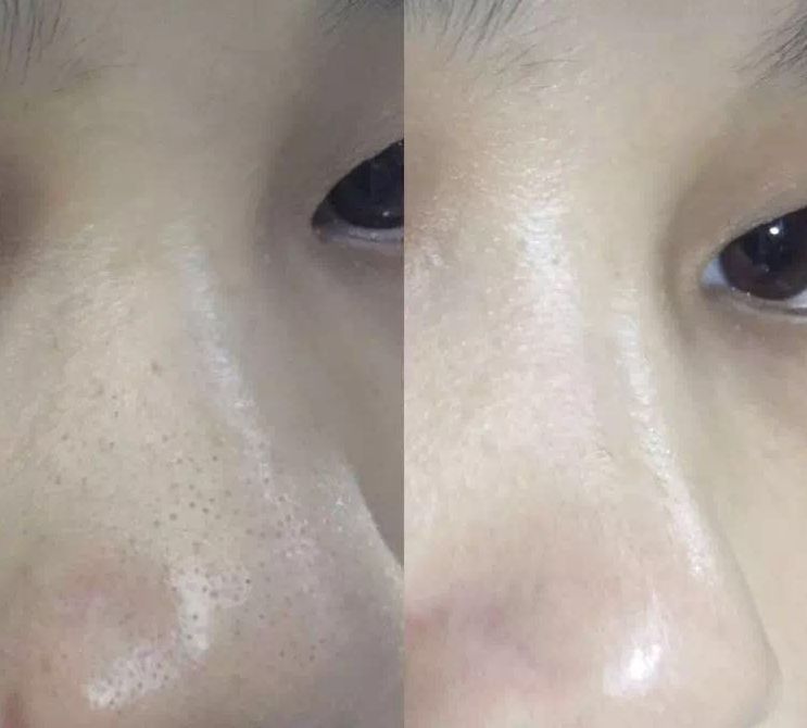 小米洁面仪真的好用吗,小米超声波洁面仪测评