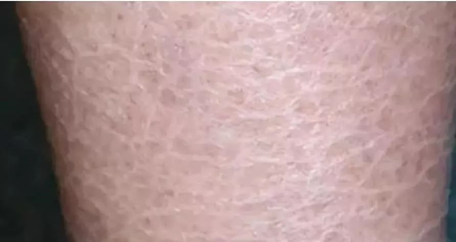 脚后跟鱼鳞状干裂用什么药,脚后跟干裂小腿长鱼鳞