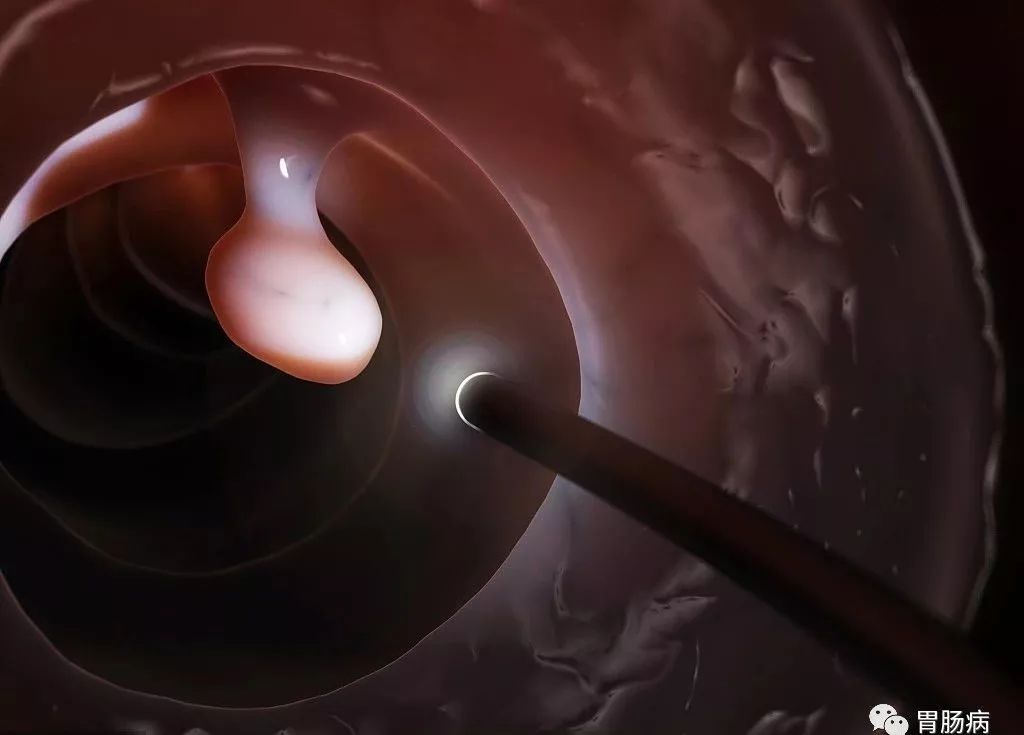 大肠息肉切除后多久要复查,大肠息肉切除多久复查一次