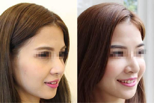 打玻尿酸,是个无底洞?真相来了!