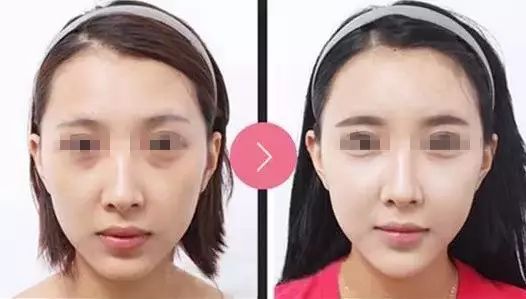 打玻尿酸,是个无底洞?真相来了!