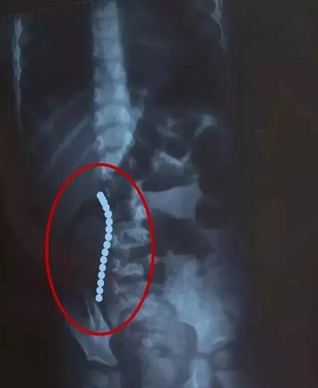 糟心熊孩子,吸铁石不小心让孩子吞了有危害吗