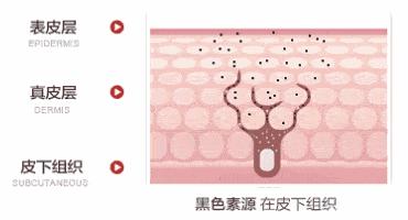 晒斑痘印去除土方法,5个祛斑小妙招淡化晒斑雀斑痘印