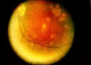 什么症状要看风湿免疫科,风湿免疫性疾病有哪些症状