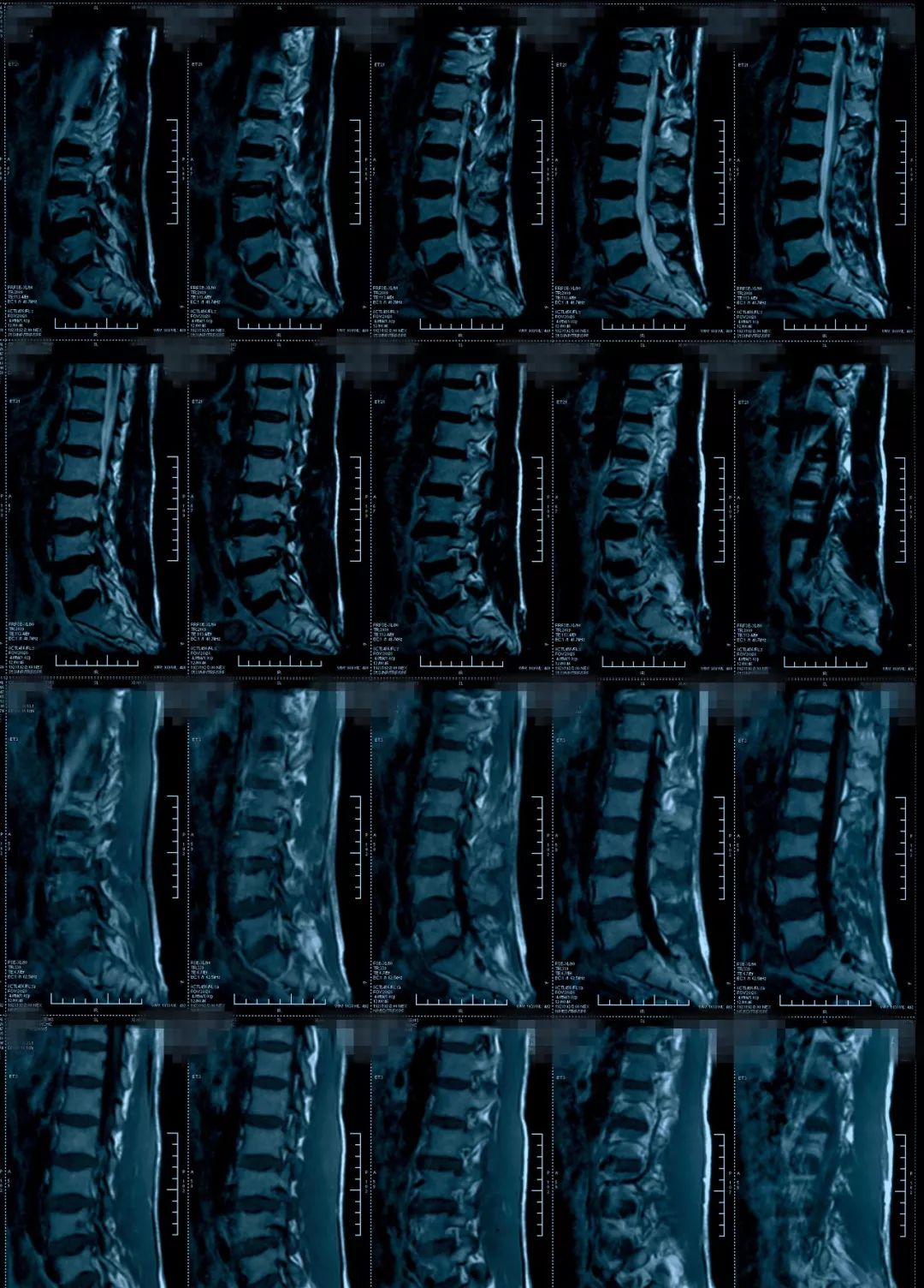 椎管狭窄水肿最佳治疗方法,椎管水肿如何治疗