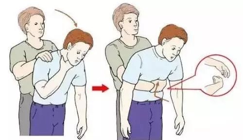 气道被异物阻塞怎么办,噎住是气道梗阻吗