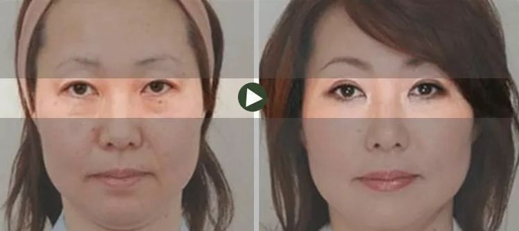 50岁没有眼袋眼纹黑眼圈,60岁去眼袋的最佳方法