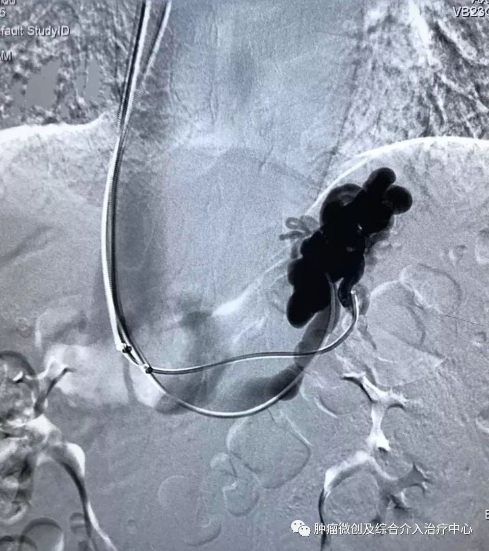 运城市第一医院肿瘤科咋样,运城第一医院治疗肿瘤怎么样