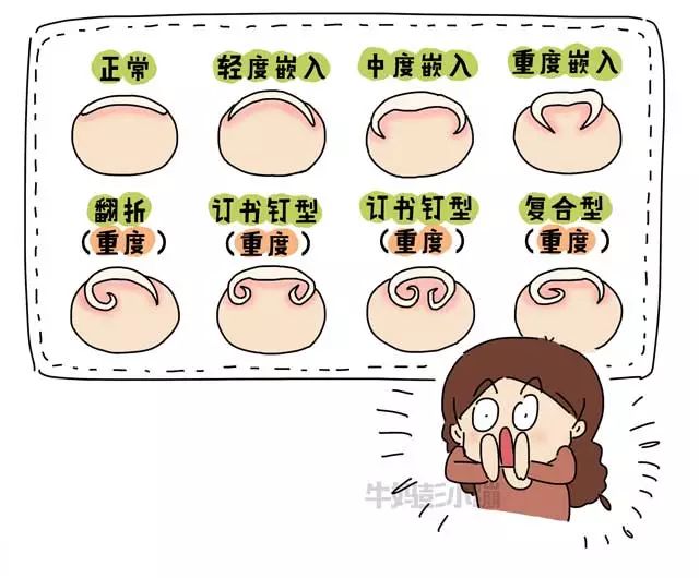 撕倒刺指甲化脓掉了,拔倒刺后指甲脱落