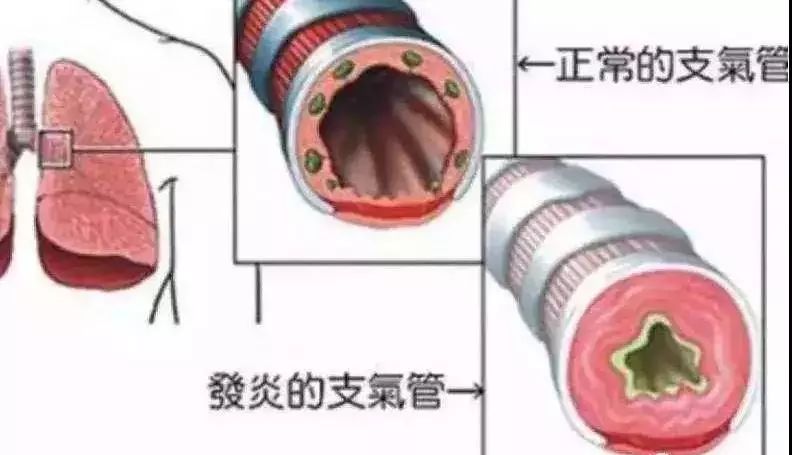 20年烟民咽喉发黑，瑞士专业医师推荐！一喷杀菌99.9%，止咳清痰排烟毒