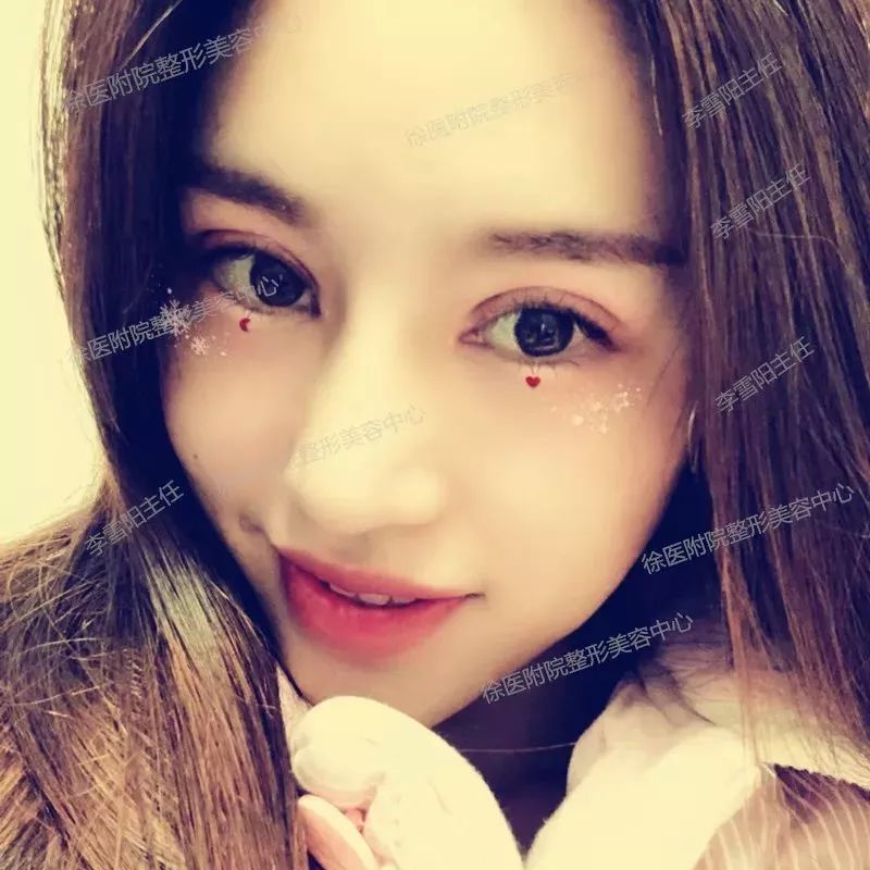 双眼皮失败又不想修复怎么办,双眼皮失败修复方法如下