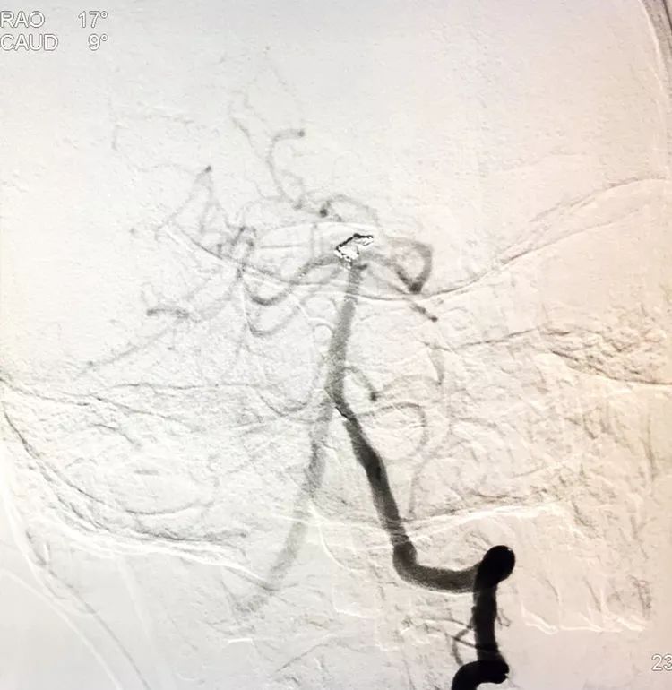 柳暗花明专栏|栓塞颅内动脉瘤时微导管无法穿过LVIS支架网眼怎么办