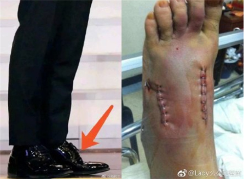 黄晓明增高鞋垫是真的吗,黄晓明增高鞋垫