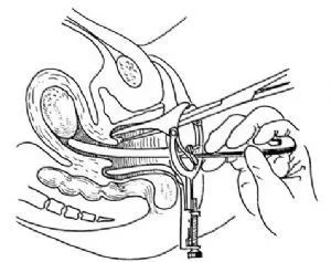 口服“他莫昔芬”子宫内膜增厚怎么办？