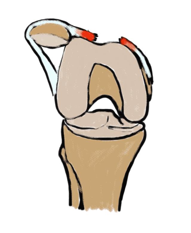 关节痛摔腿,关节弯曲痛打直就没事了
