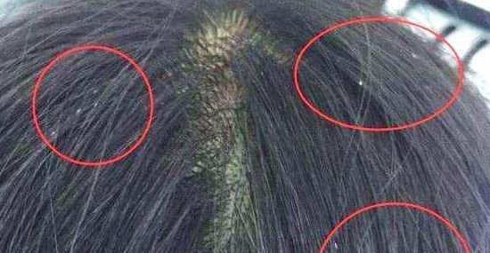 头上头皮屑和剪发虫怎么解决,头皮屑多且大块还结痂会不会有虫