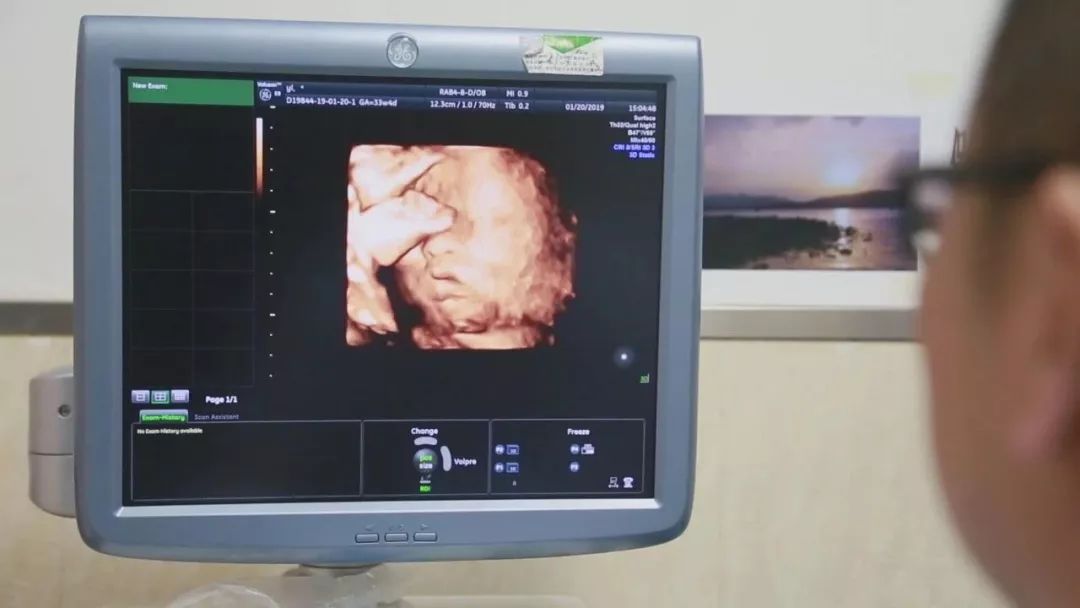 中国首例子宫移植女人顺利分娩,中国首例试管婴儿生下第二代宝宝