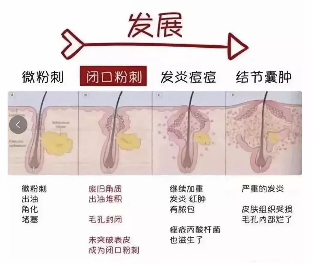 祛痘药膏活动,祛痘医疗活动方案