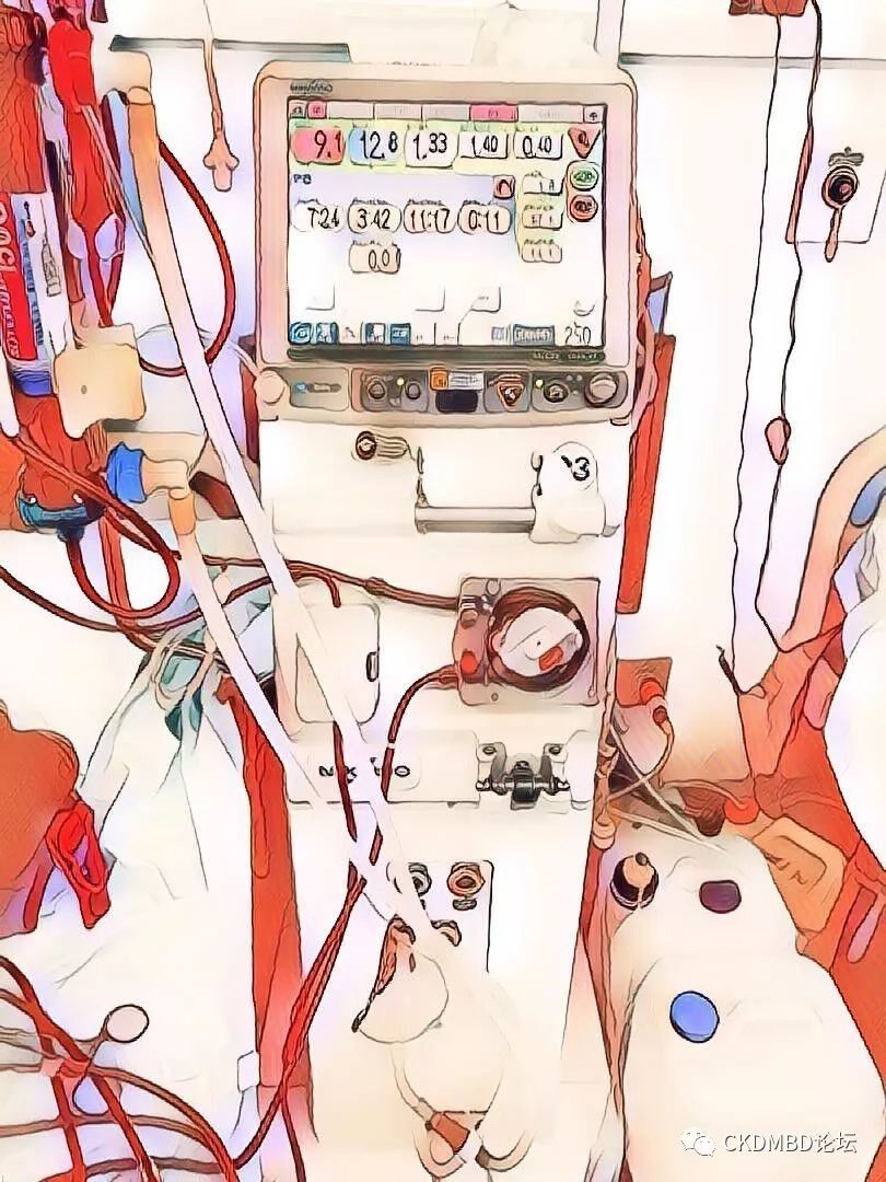 甲状旁腺射频消融术的全过程,后悔做甲状旁腺射频消融