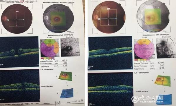 咸阳第一人民医院眼睛手术,咸阳市第一人民医院眼科飞秒手术