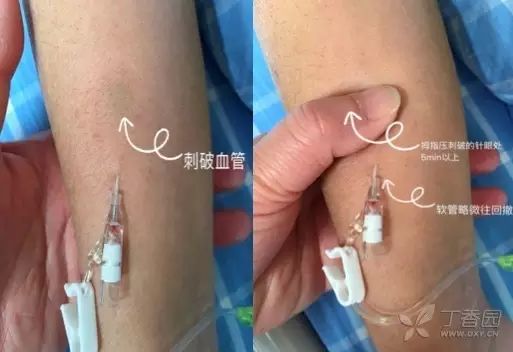 输液刺破血管补救办法,打针刺破血管是如何恢复的