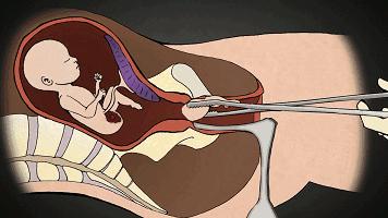 与男友共度这一夜后,24岁女孩差点……(附避孕科普)