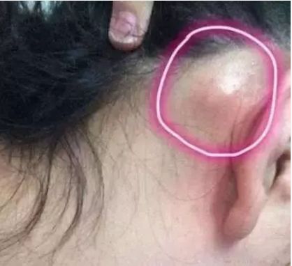 你的耳后有鼓包吗赶紧对照看看,耳后有个鼓包怎么回事