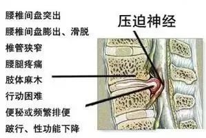 久坐相当“慢性自杀”!德国骨科专家打造的“撑腰”神器,坐9小时腰也不痛,20年颈脊椎病都好了