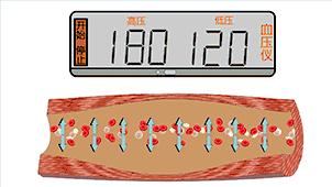血管堵演示,血管堵塞100张图片
