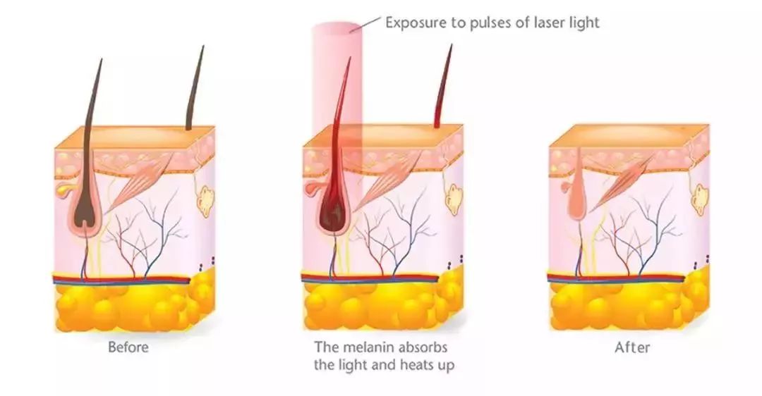 春天要来了，宝贝你怎么长胡子了？（脱毛秘籍）