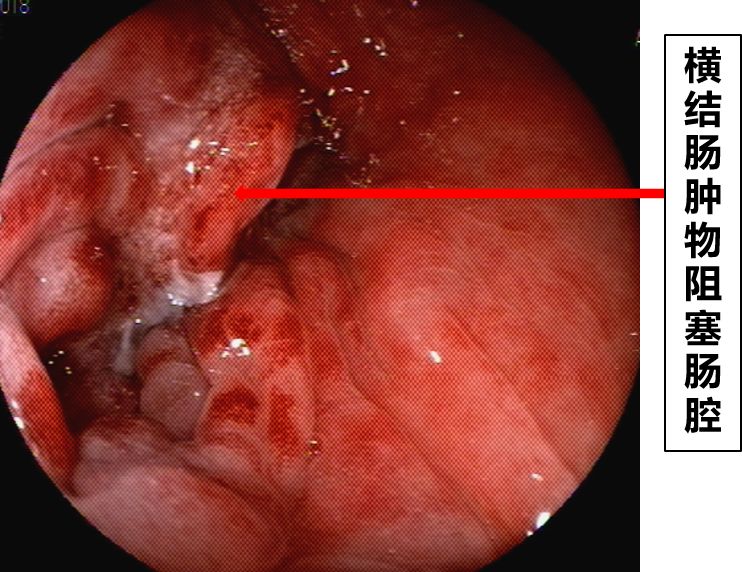 消化道支架置入术,消化道梗阻支架怎么放