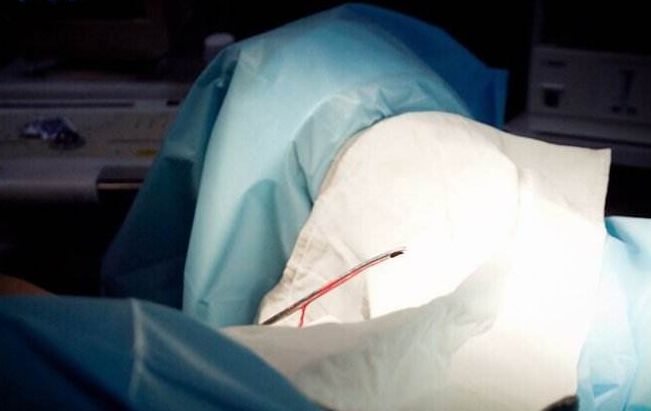 女孩6年17次人流,22岁未婚女性人流