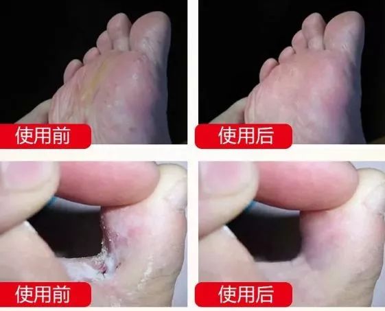 脚臭怎么办教你除臭小妙招,脚痒脚臭怎么办教你除臭方法
