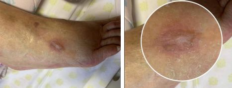 热水袋烧伤,热水袋烧伤起泡怎么处理