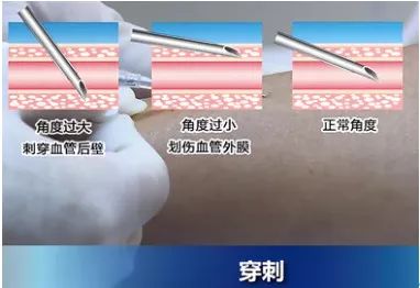 扎留置针有回血送针失败,留置针回血穿刺失败