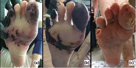 坏疽是一种特殊类型的坏死,雷诺干燥综合征怎么治疗