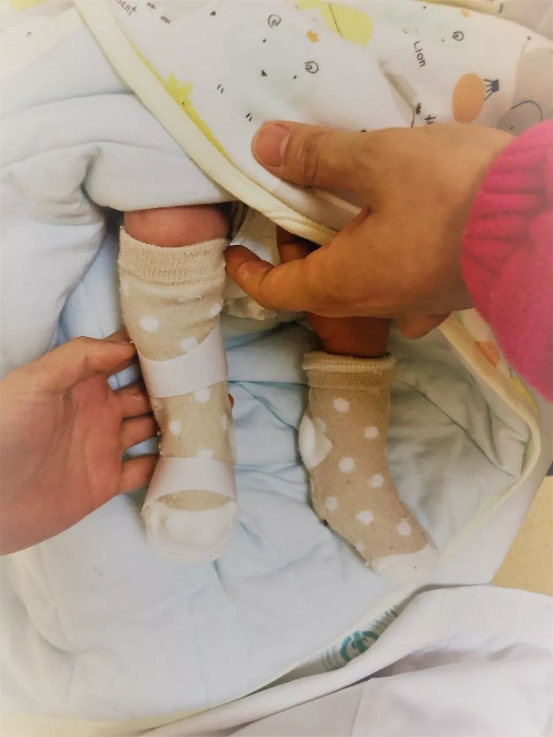 刚出生就要打石膏?硬核医生手工打造矫形器治疗足外翻
